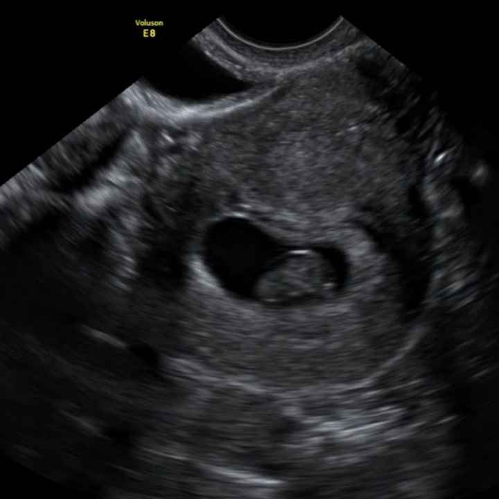 Ayuda con método ramzi: niño o niña? - 1