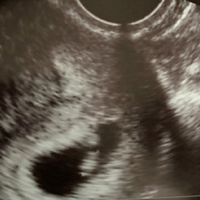 Ayuda con método ramzi: niño o niña? - 1