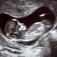 Ayuda con método ramzi: niño o niña? - 1