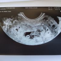Ayuda con método ramzi: niño o niña? - 1