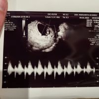 Ayuda con método ramzi: niño o niña? - 1