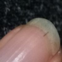 Rayas negras en las uñas de las manos - 1