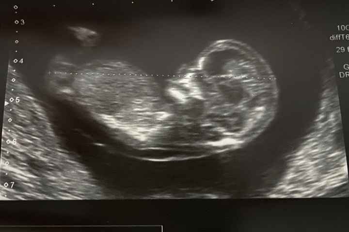 Ayuda con método ramzi: niño o niña? - 2
