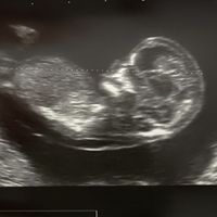 Ayuda con método ramzi: niño o niña? - 2