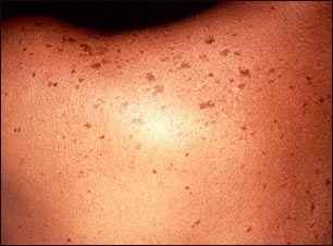 pecas en la espalda
