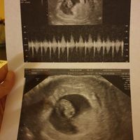 Ayuda con método ramzi: niño o niña? - 1