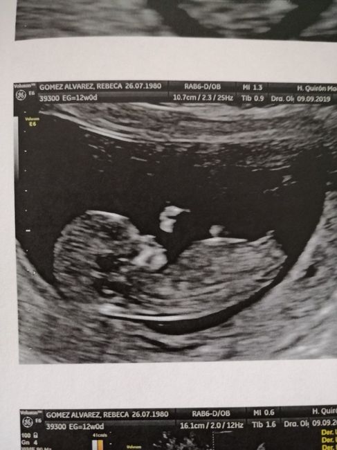 Tubérculo genital: niña - 1