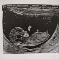 Tubérculo genital: niña - 1