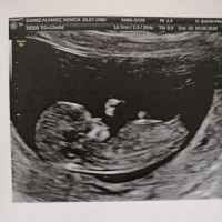 Tubérculo genital: niña - 1
