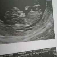 Tubérculo genital: niña - 1