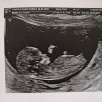 Tubérculo genital: niña - 1