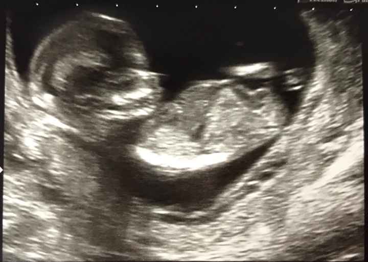 Ayuda con método ramzi: niño o niña? 14