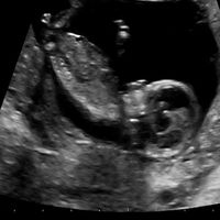 Ayuda con método ramzi: niño o niña? - 1