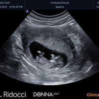 Ayuda con método ramzi: niño o niña? - 1