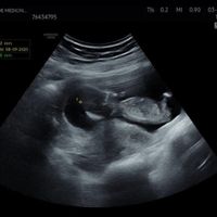 Alguien sabe identificar el sexo del bebe según el tubérculo? - 2