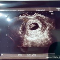 Ayuda con método ramzi: niño o niña? - 1