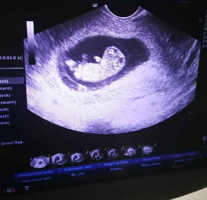 Ayuda con método ramzi: niño o niña? - 1