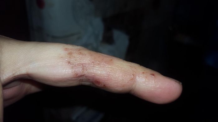 Alergia 2