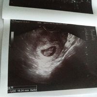 Ayuda con método ramzi: niño o niña? - 1