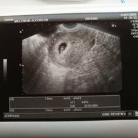 Ayuda con método ramzi: niño o niña? - 1
