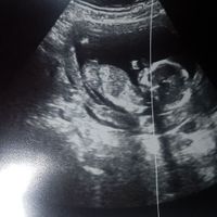 Ayuda con método ramzi: niño o niña? - 2