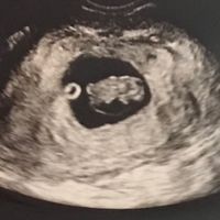 Ayuda con método ramzi: niño o niña? - 1