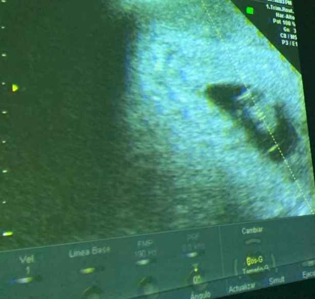 Ayuda con método ramzi: niño o niña? 2