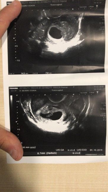 Tubérculo genital niño o niña??? 7