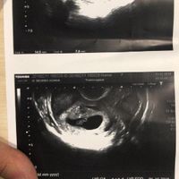 Tubérculo genital niño o niña??? - 1