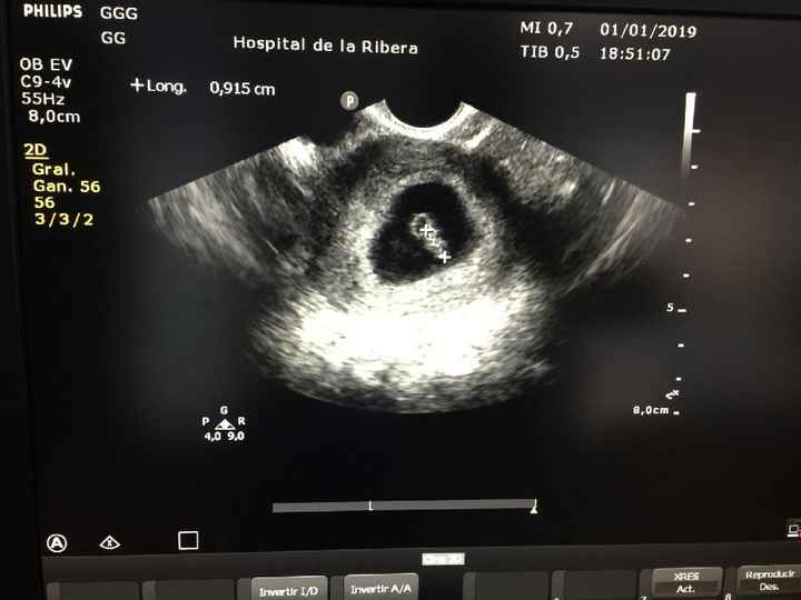 Ayuda con método ramzi: niño o niña? - 1