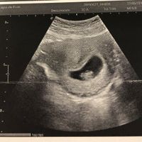 Ayuda con método ramzi: niño o niña? - 1
