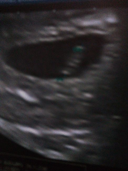 Ayuda con método ramzi: niño o niña? - 1