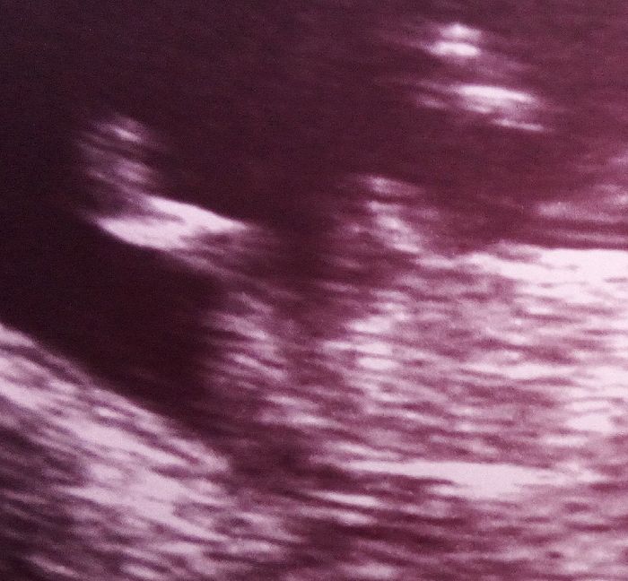 Ayuda con método ramzi: niño o niña? - 1