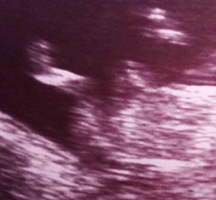 Ayuda con método ramzi: niño o niña? - 1