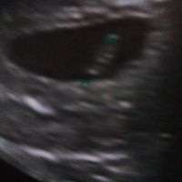 Ayuda con método ramzi: niño o niña? - 1