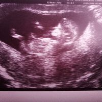 Ayuda con método ramzi: niño o niña? - 1