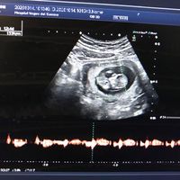Ayuda con método ramzi: niño o niña? - 1