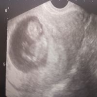Ayuda con método ramzi: niño o niña? - 1