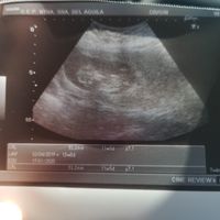 Ayuda con método ramzi: niño o niña? - 1
