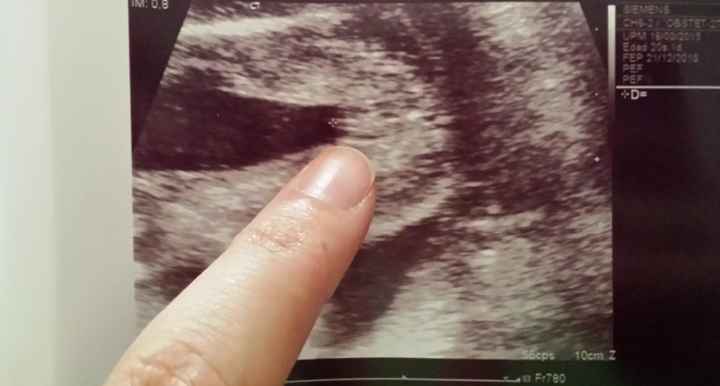 Niña eco 20 semanas