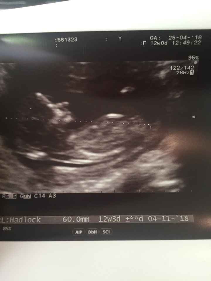 Ayuda con método ramzi: niño o niña? - 3