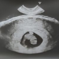 Ayuda con método ramzi: niño o niña? - 1