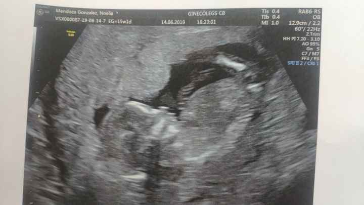 Tubérculo genital: niña - 1