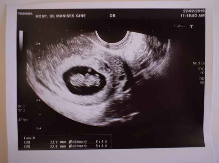 Eco vaginall 9 semanas