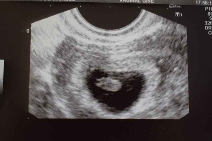 y esta de mi prima, eco vaginal semana 8
