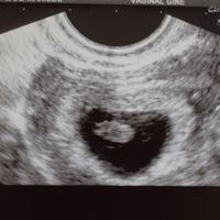 y esta de mi prima, eco vaginal semana 8