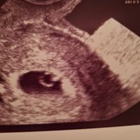 Ayuda con método ramzi: niño o niña? - 1