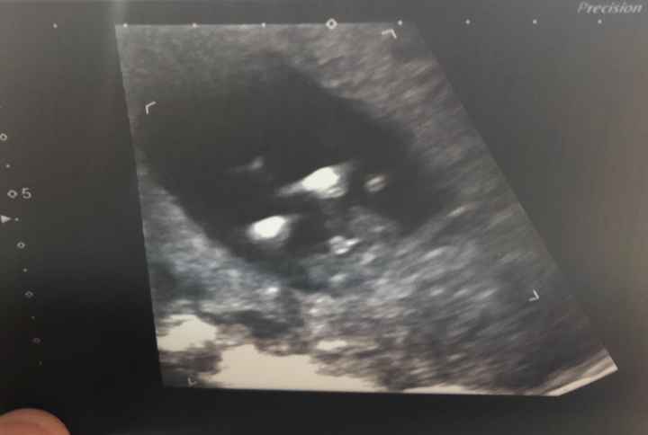 Tubérculo genital: niña 10