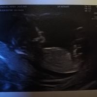 Ayuda con método ramzi: niño o niña? - 1