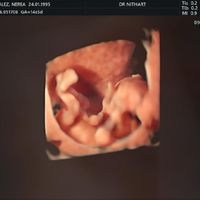 Ayuda con método ramzi: niño o niña? - 1